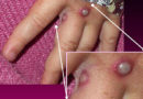 MONKEYPOX DISEASES: Why are monkeypox cases rising?